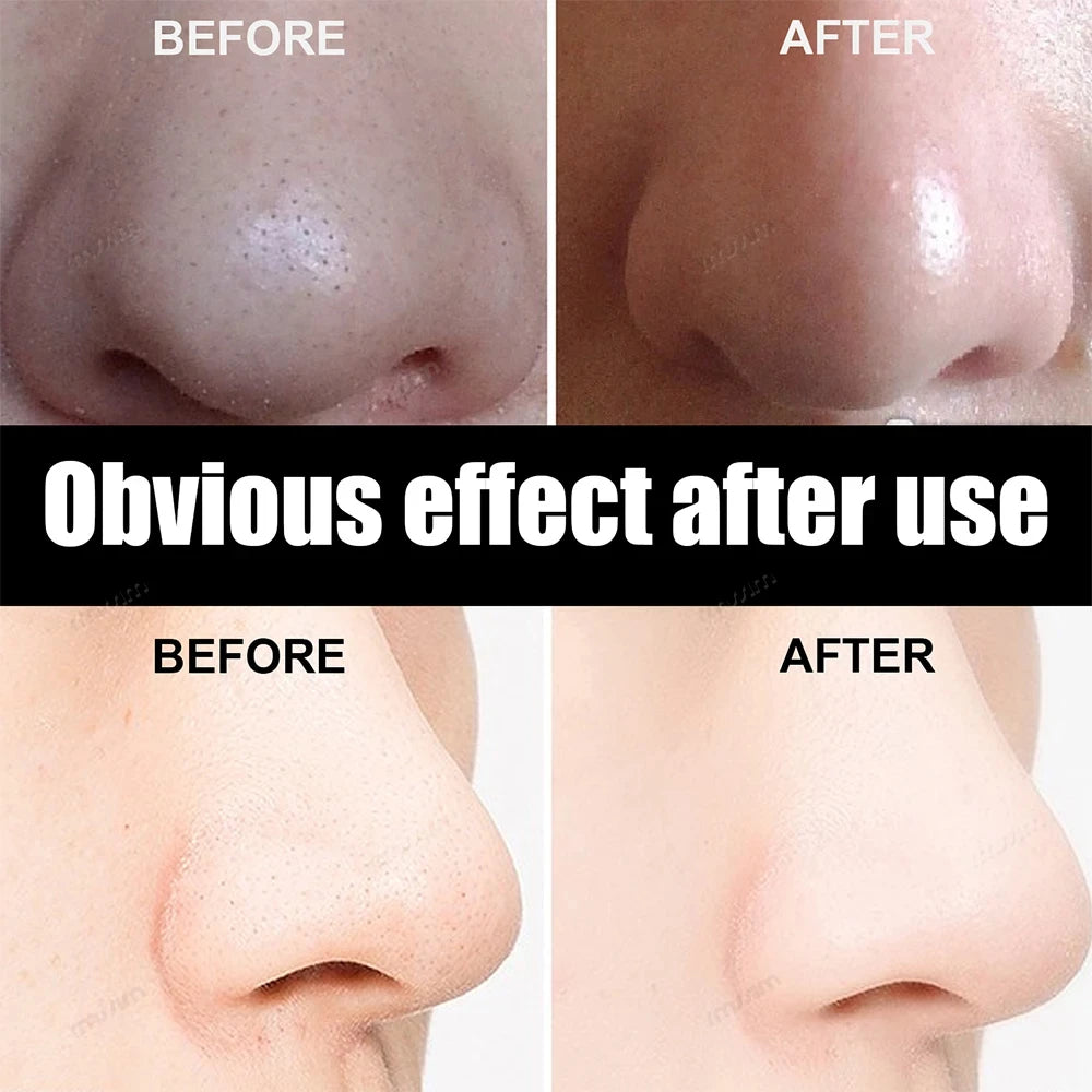 50/100PCS Bamboo Charcoal Nasal Strips Blackhead Remover
